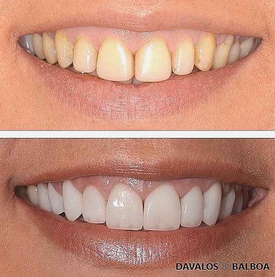 Estética dental: carillas de porcelana 