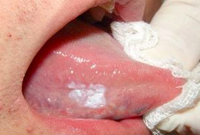 alt+Oral Leukoplakia