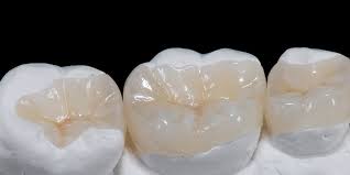 alt+dental inlays