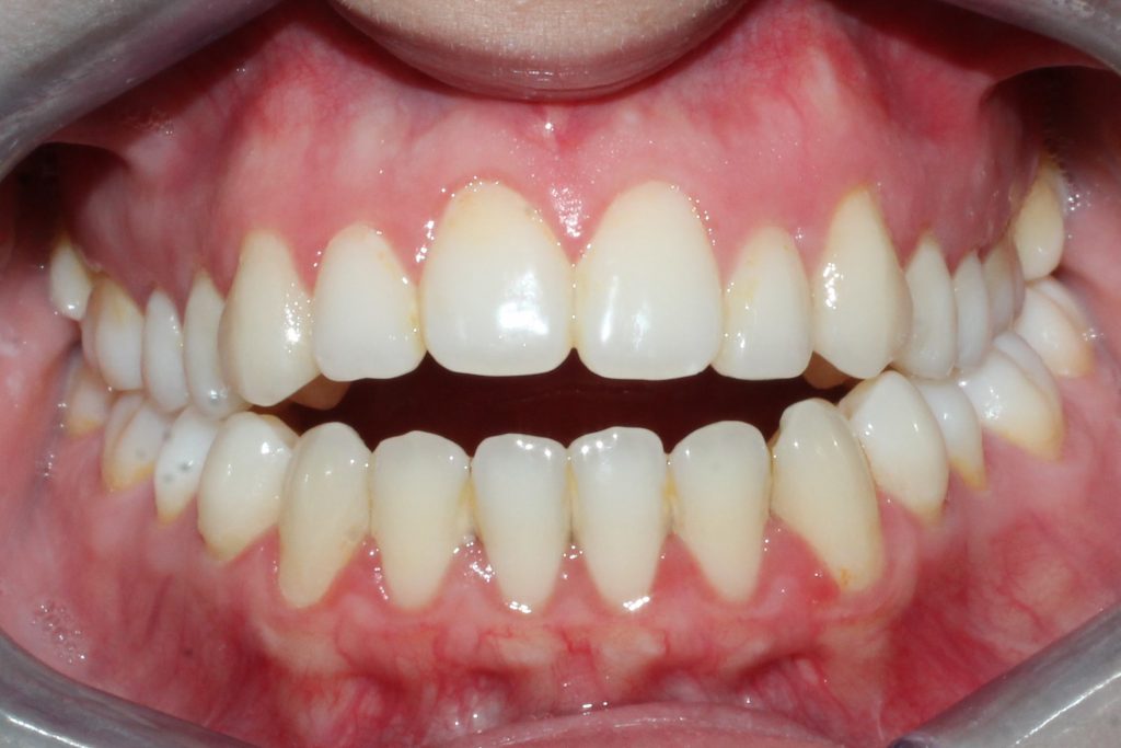 alt+¿Qué es la Maloclusión Dental? 
