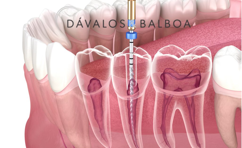 Endodoncia en Murcia. ¿Qué debes saber? - Clínica dental ...