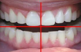 alt+Diferencia entre Limpieza Dental y Curetajes