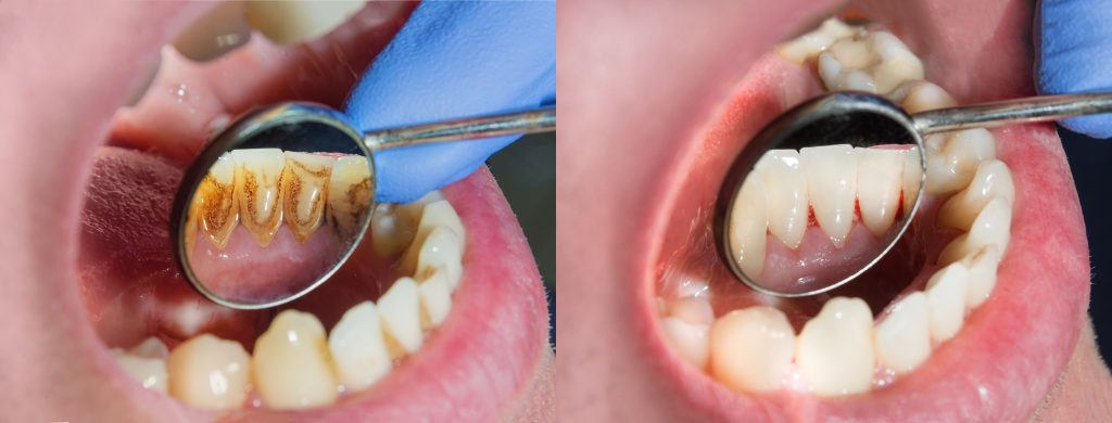 alt+Curetajes o Limpieza Dental  ¿Cuál es la mejor opción para ti? 