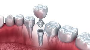 alt+Especialista en Implantes Dentales en Murcia 
