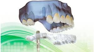 alt+Implantes Dentales sin Cirugía en Murcia