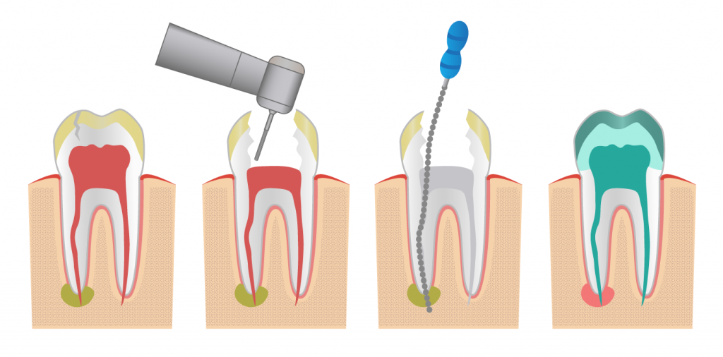 dientes endodoncia