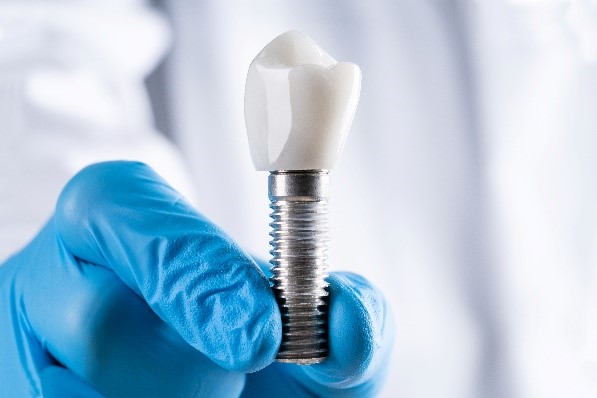 implantes dentales en murcia