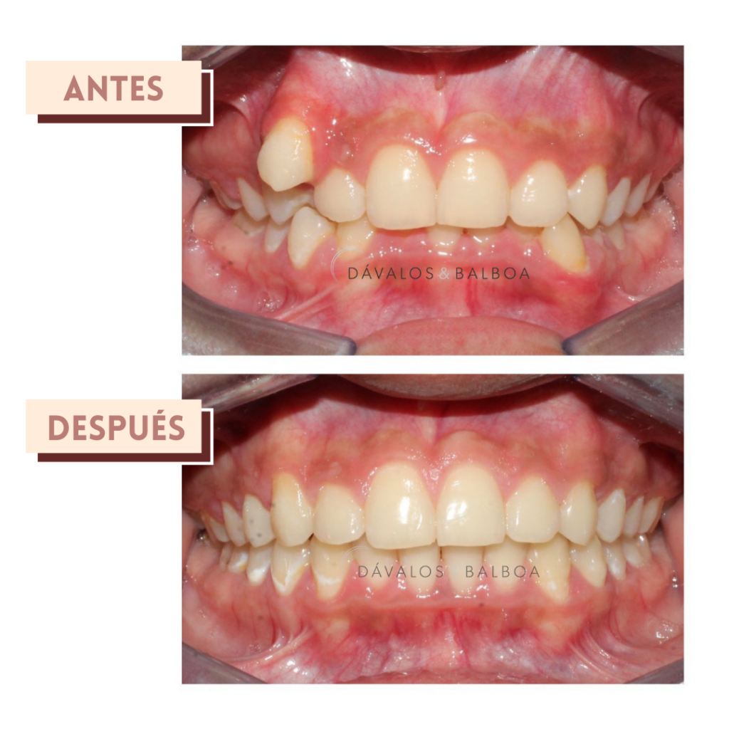 casos de ortodoncia en Murcia