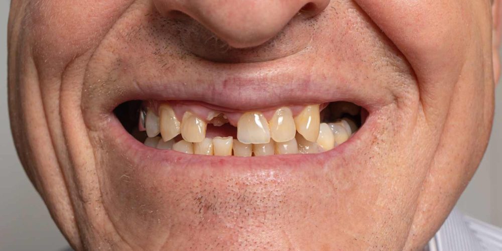 AUSENCIA DENTAL