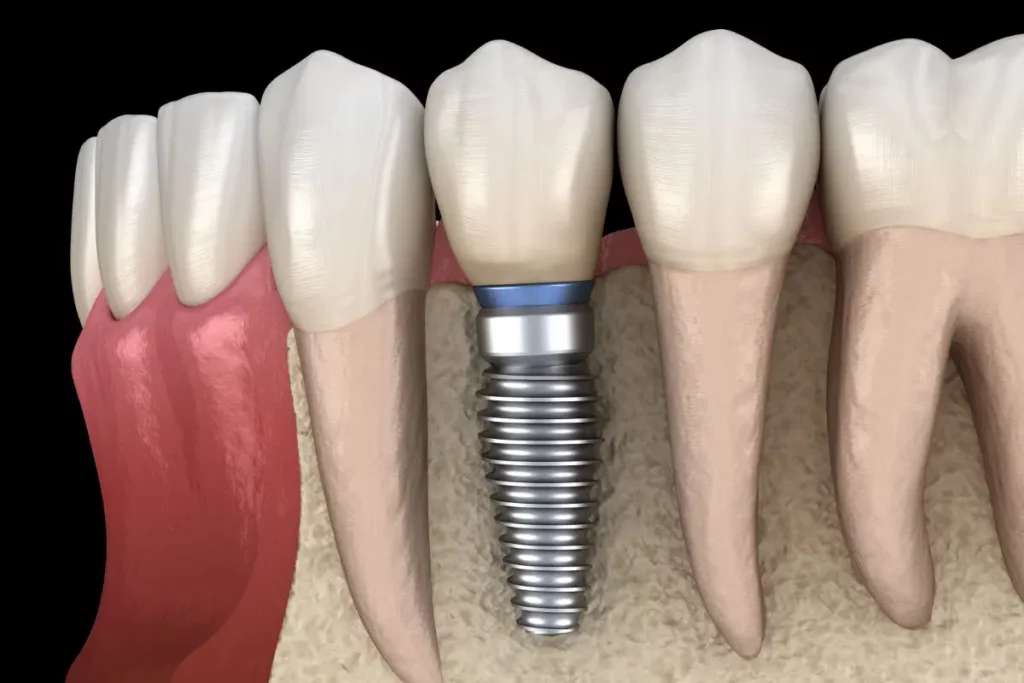 IMPLANTE DENTAL