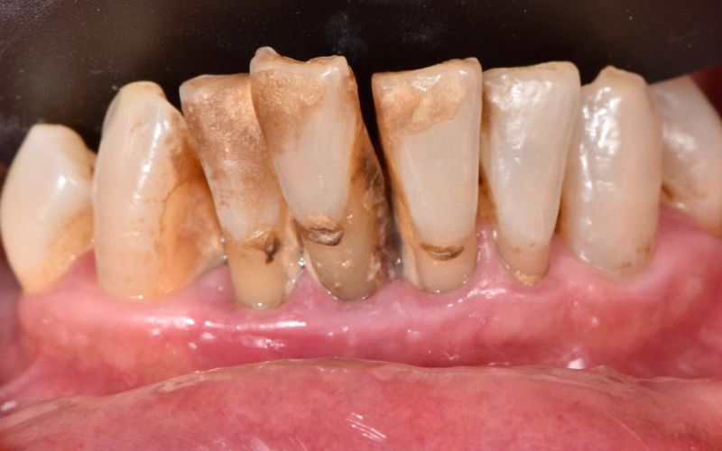 Dientes afectados por tabaco