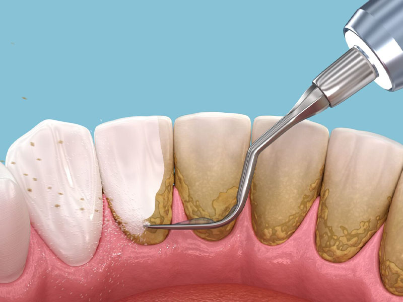 Limpieza bucodental