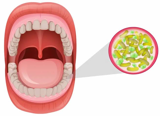 Halitosis