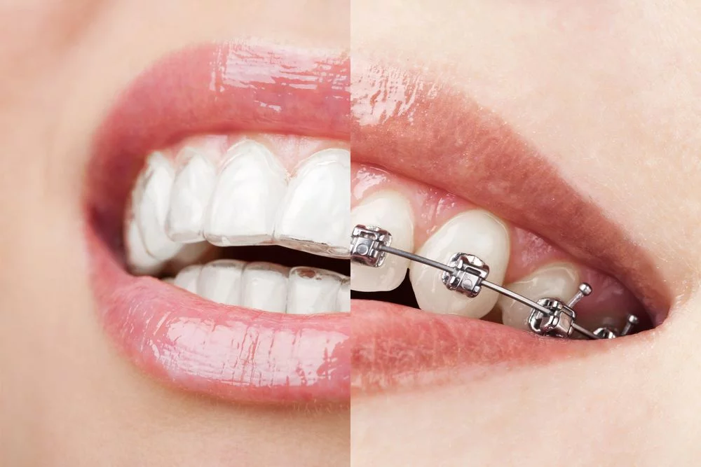 Brackets vs Alineadores