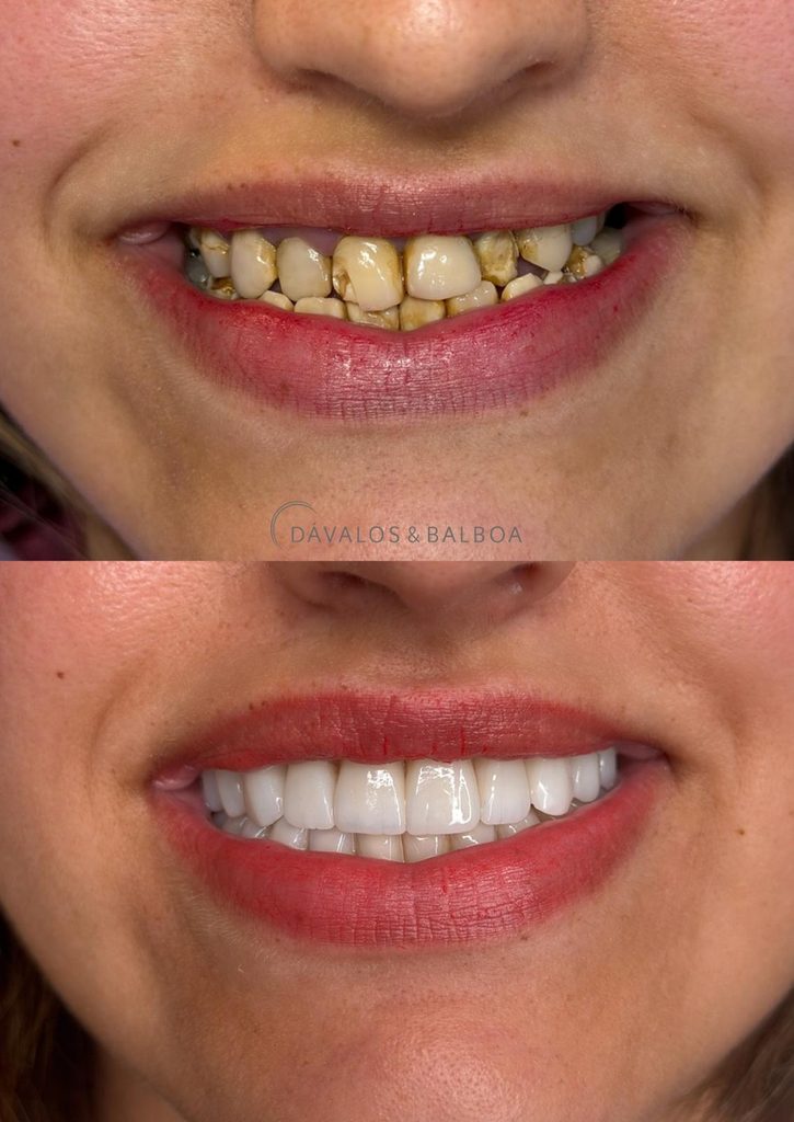 ANTES Y DESPUÉS AMELOGÉNESIS IMPERFECTA