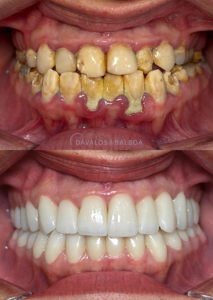 CASO ANTES Y DESPUÉS AMELOGENEIS IMPERFECTA